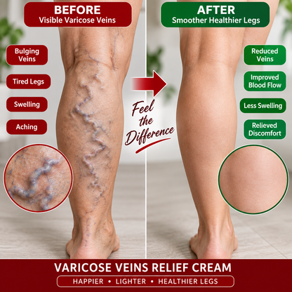 Varicose Veins Relief Cream
