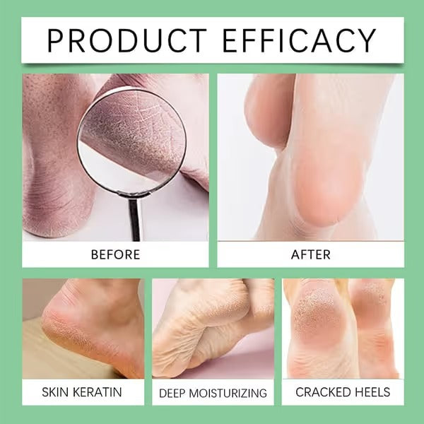 🦶 7 Days Ginger Foot Repair Spray™ – Cracked Heel & Dry Foot Care Solution